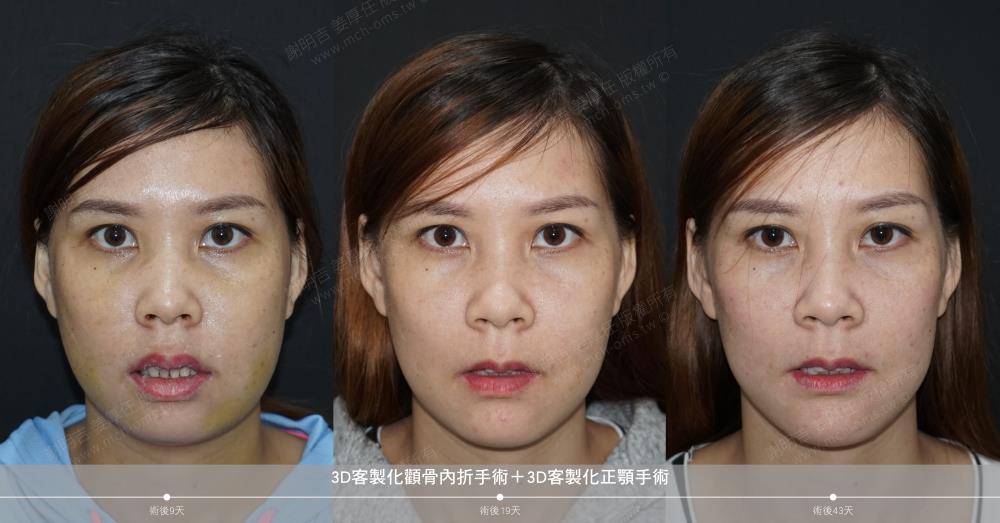 正顎手術 恢復期 手術前後比較 手術照片 手術案例