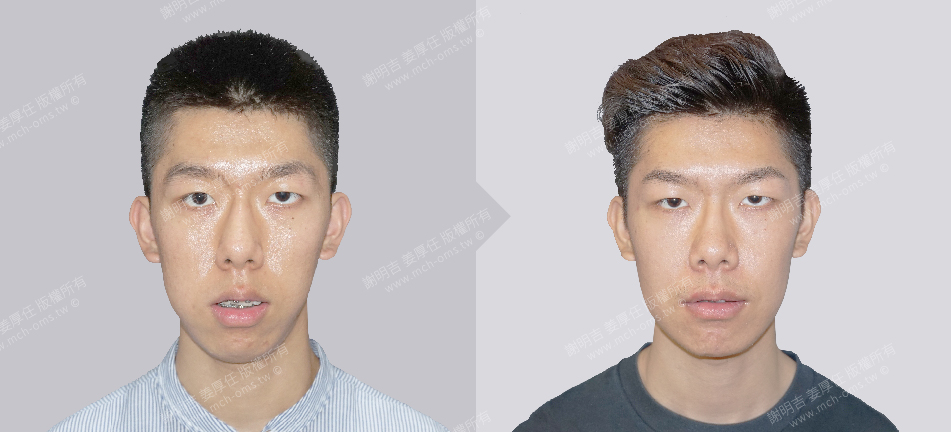 正颚手术 恢复期 手术前後比较 手术照片 手术案例 削骨手术