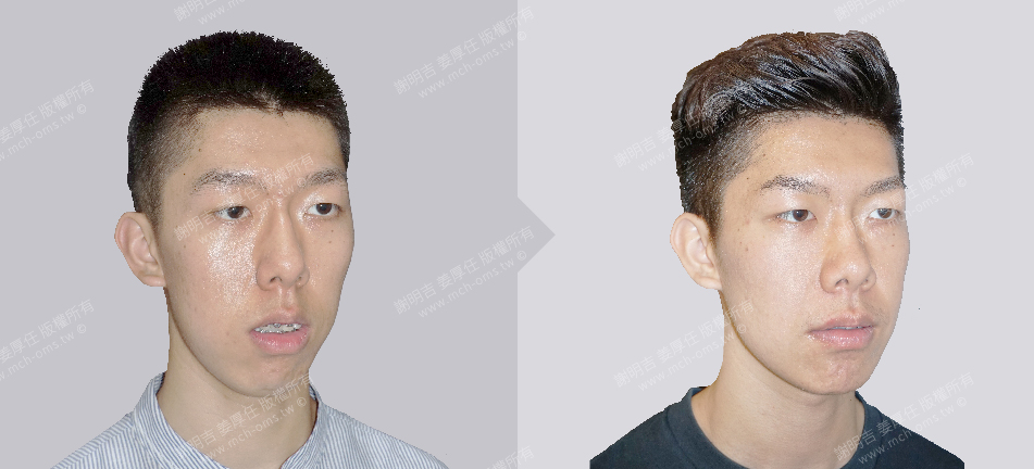 正颚手术 恢复期 手术前後比较 手术照片 手术案例 削骨手术