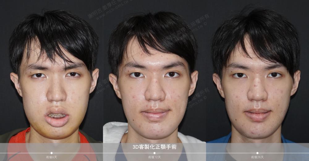 正顎手術 恢復期 手術前後比較 手術照片 手術案例