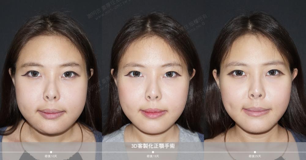 正顎手術 恢復期 手術前後比較 手術照片 手術案例
