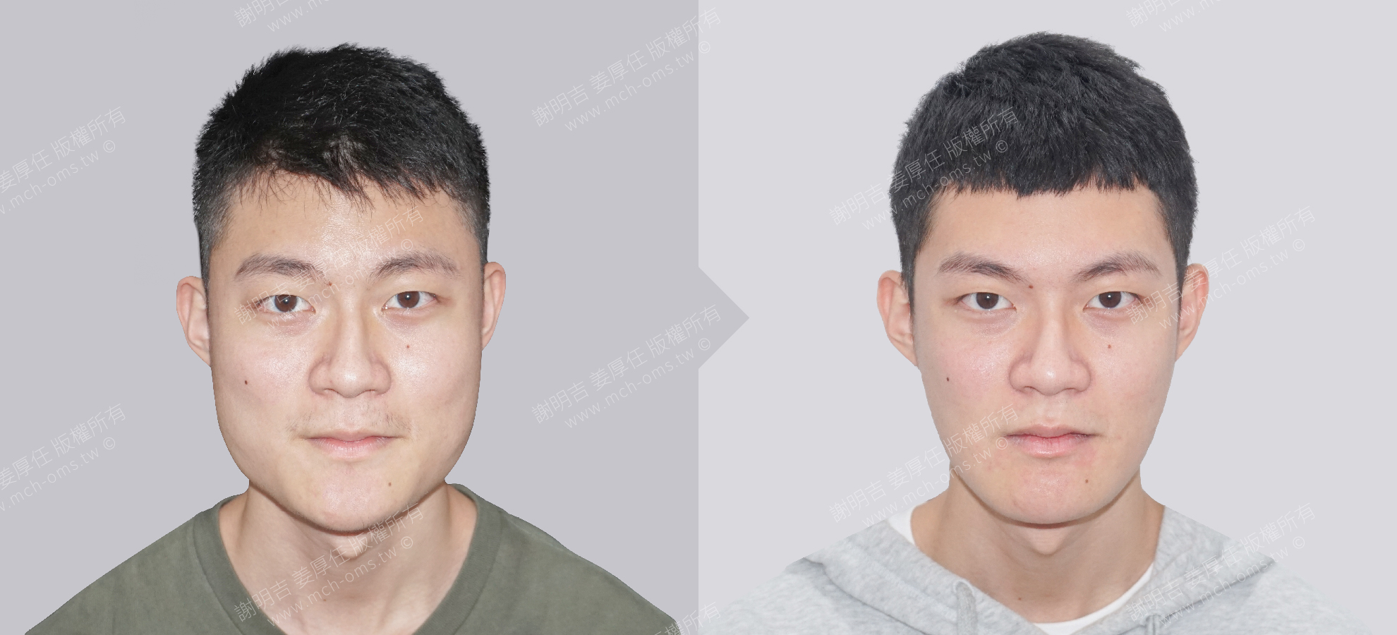 削骨手術 顴骨削骨 下顎骨削骨 國字臉