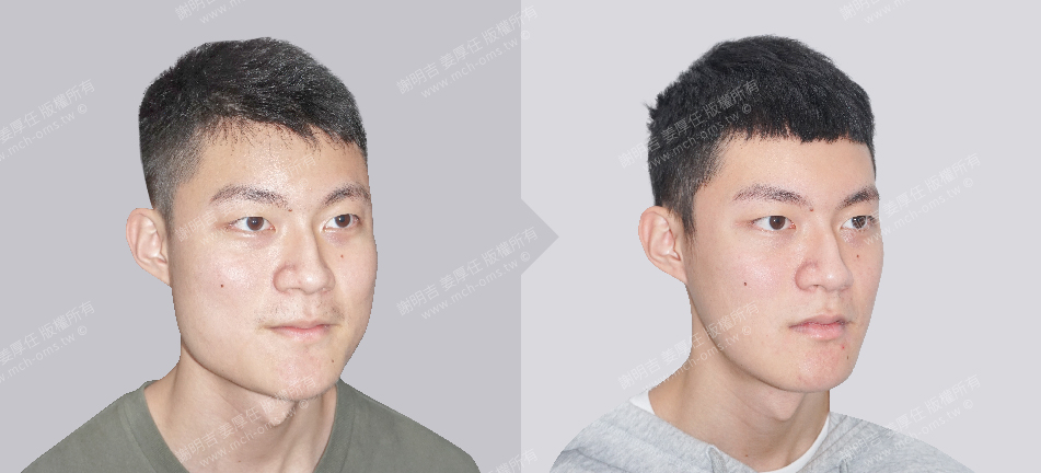 削骨手術 顴骨削骨 下顎骨削骨 國字臉