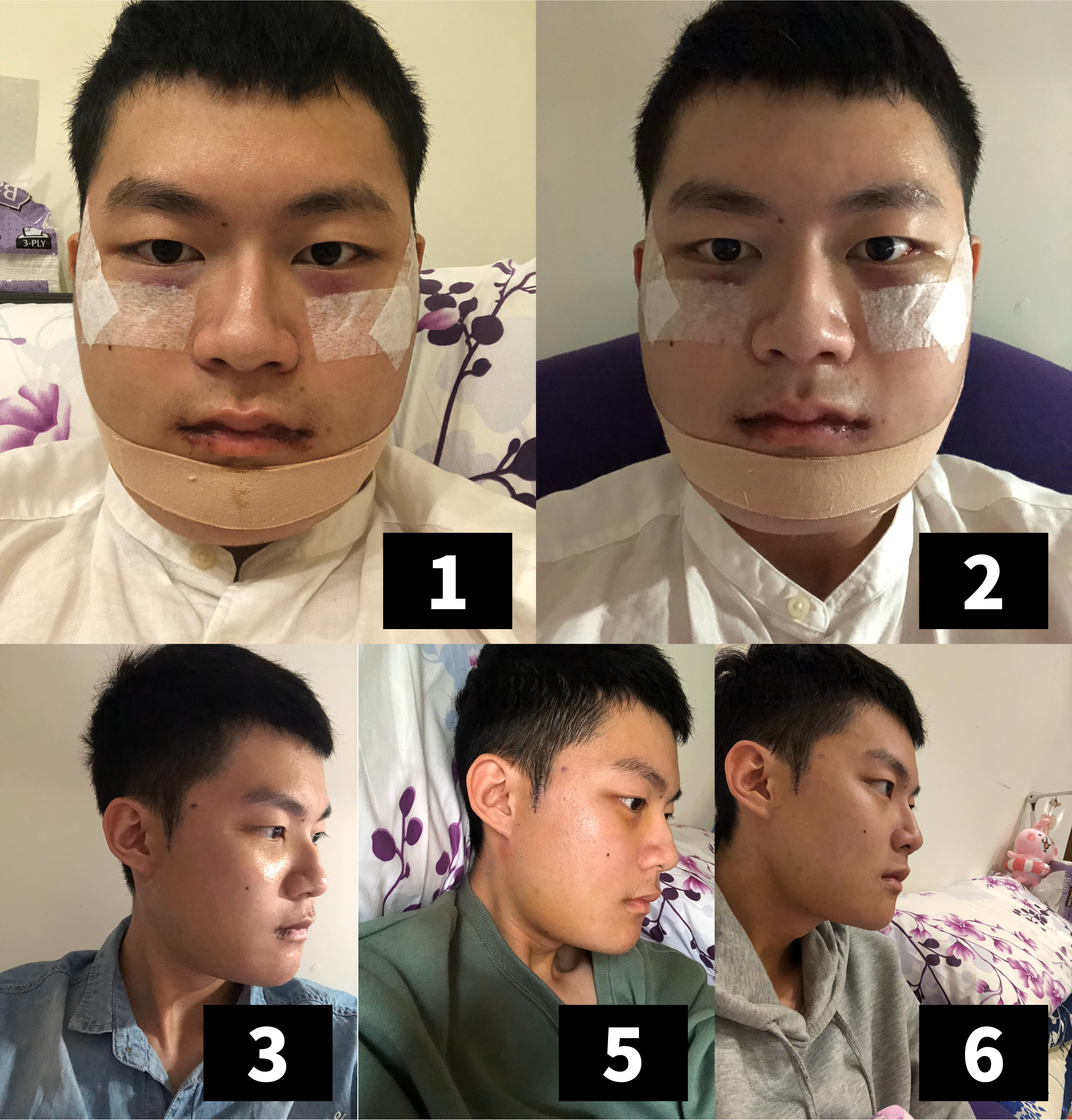 削骨手術 顴骨削骨 下顎骨削骨 國字臉