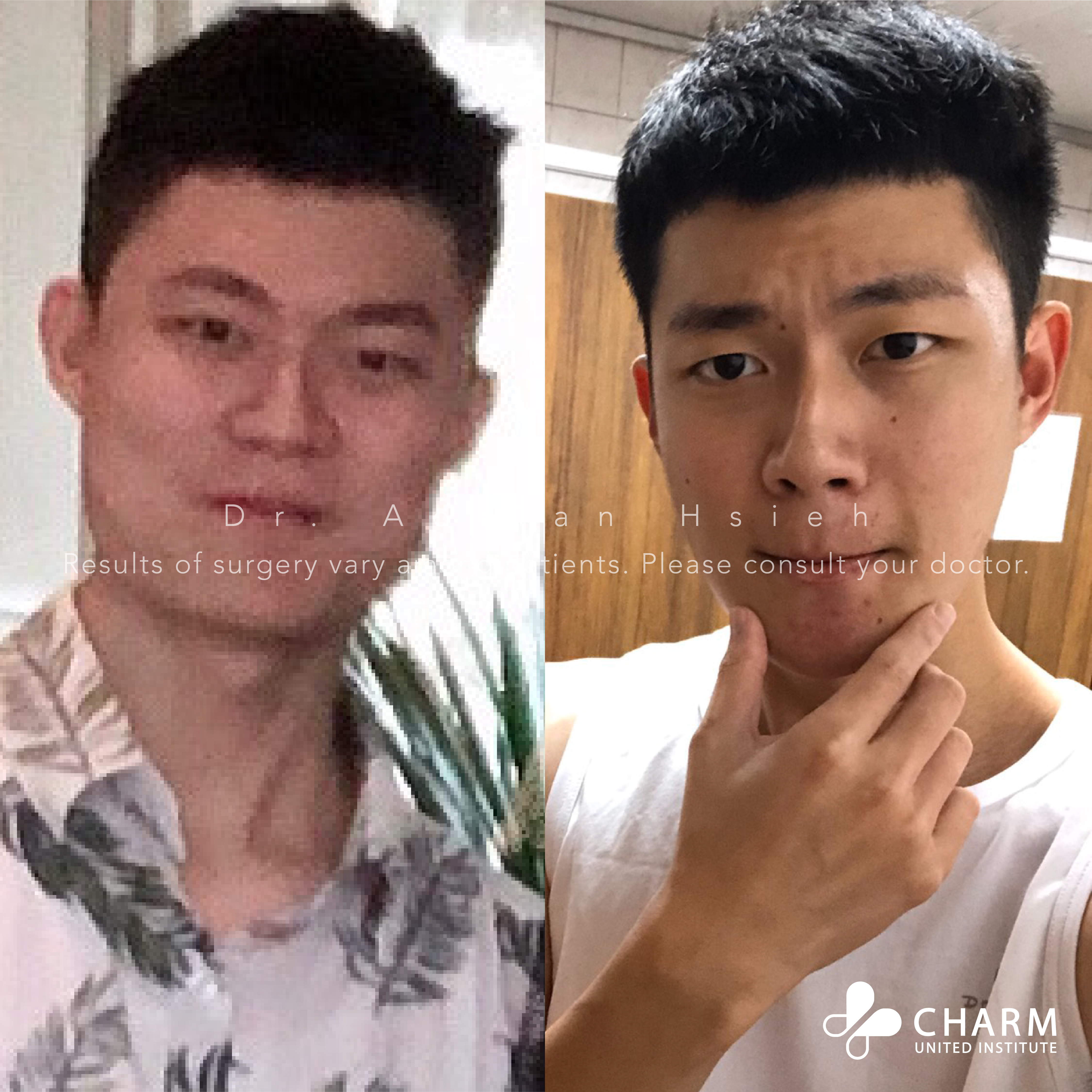 削骨手術 顴骨削骨 下顎骨削骨 國字臉