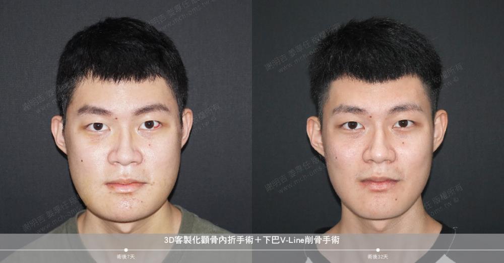 削骨手術 顴骨削骨 下顎骨削骨 國字臉