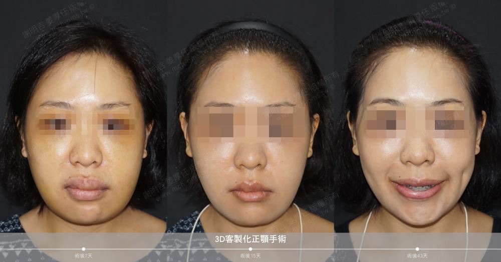 正颚手术 恢复