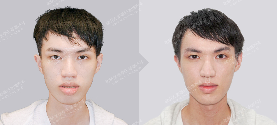 正顎手術 恢復期 手術前後比較 手術照片 手術案例 削骨手術