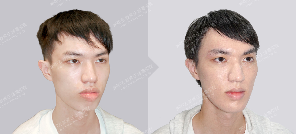 正顎手術 恢復期 手術前後比較 手術照片 手術案例 削骨手術