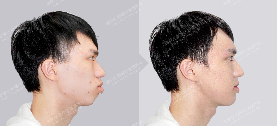正顎手術 恢復期 手術前後比較 手術照片 手術案例 削骨手術