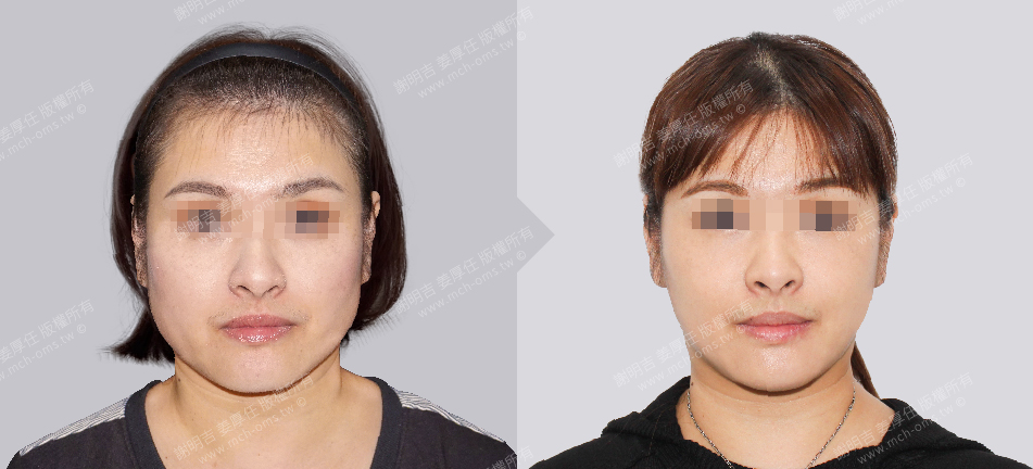 正颚手术 恢复期 手术前後比较 手术照片 手术案例 削骨手术