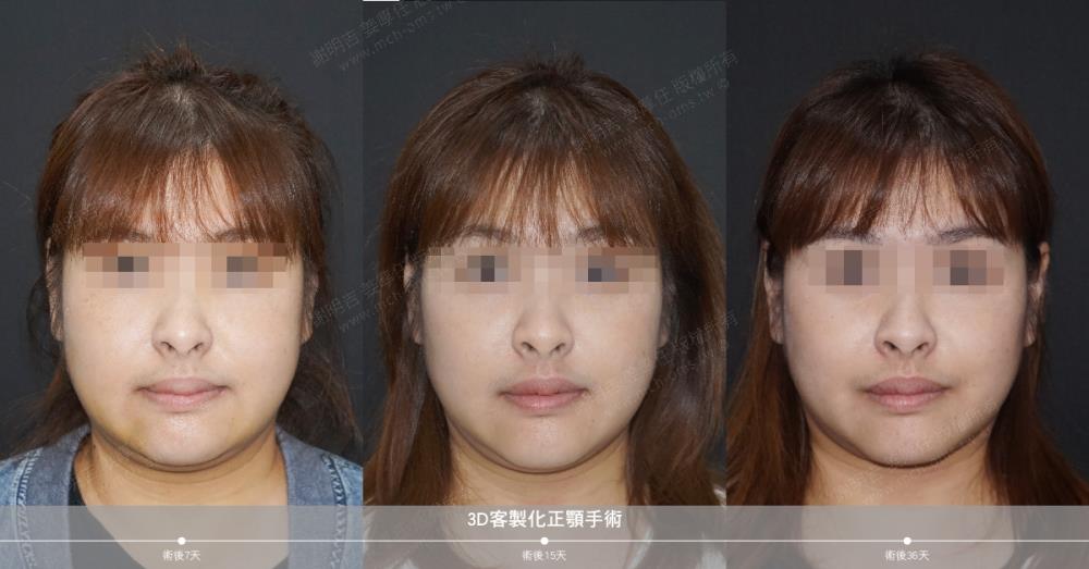 正颚手术 恢复期 手术前後比较 手术照片 手术案例