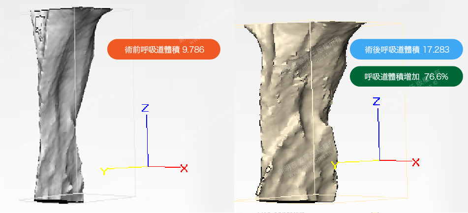 正颚手术 正颚 睡眠呼吸中止 打呼 打鼾 呼吸道 阳压呼吸器