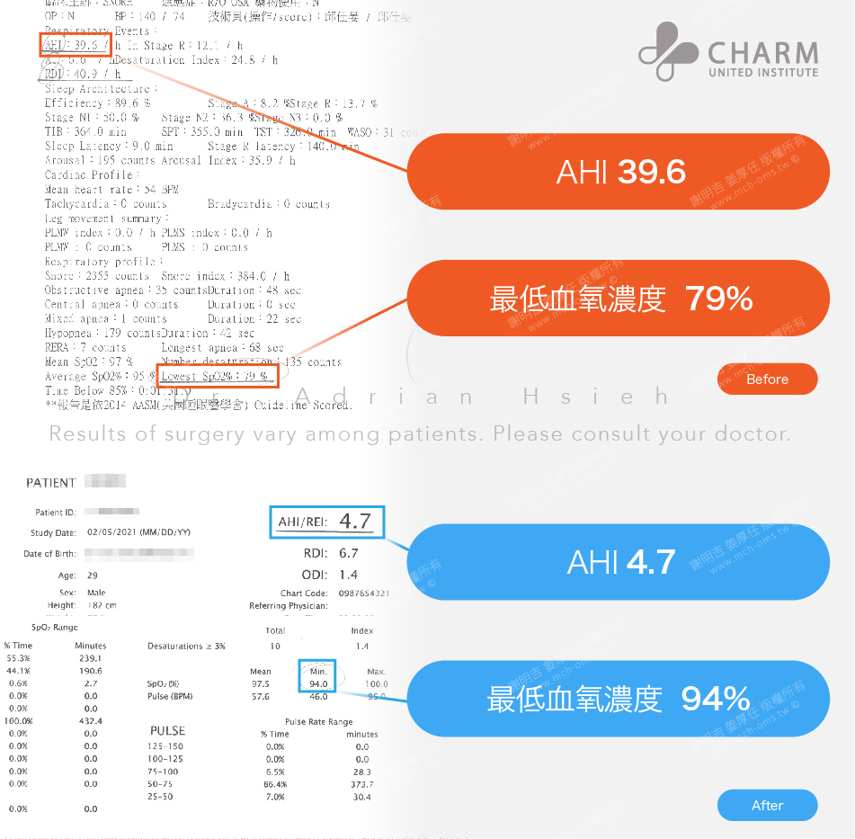 正颚手术 正颚 睡眠呼吸中止 打呼 打鼾 呼吸道 阳压呼吸器