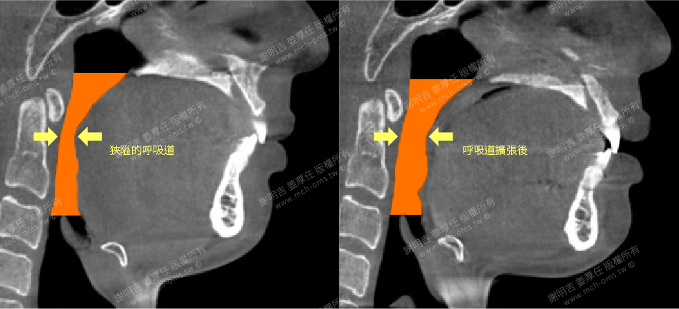 正颚手术 正颚 睡眠呼吸中止 打呼 打鼾 呼吸道 阳压呼吸器