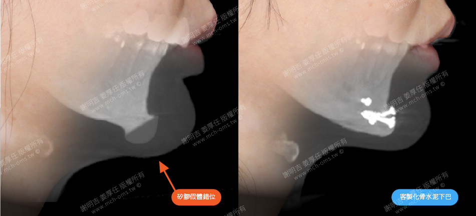 正顎手術 恢復下巴整形,墊下巴,列印下巴,骨水泥下巴,訂製下巴,下巴美型,暴牙,後縮,下巴手術,下巴失敗,Dr. Adrian M. Hsieh