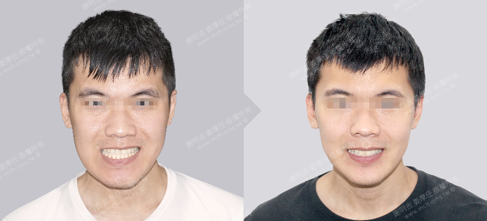 正顎手術 失敗 正顎手術失敗 戽斗 歪斜
