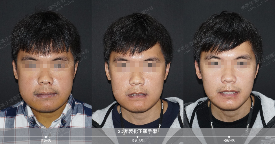 正顎手術 恢復 恢復期 我的恢復週記 正顎手術恢復