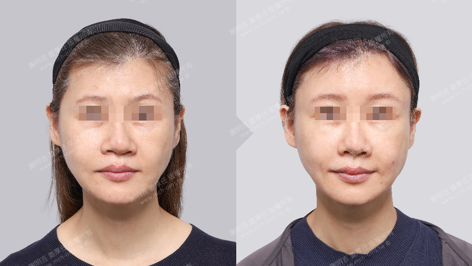 正颚手术 失败 正颚手术失败 戽斗 歪斜