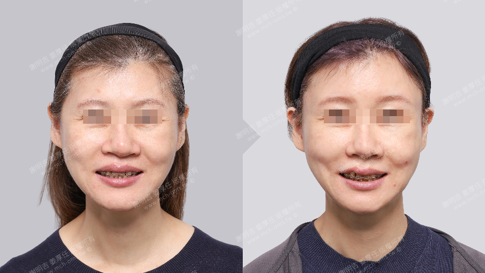 正颚手术 失败 正颚手术失败 戽斗 歪斜