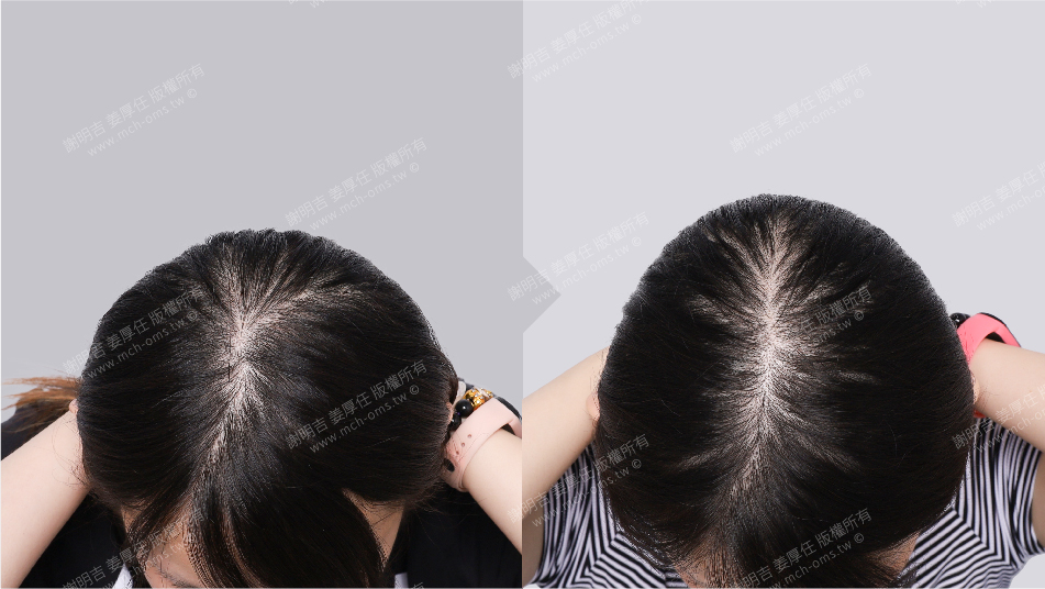 後腦勺 扁頭 手術