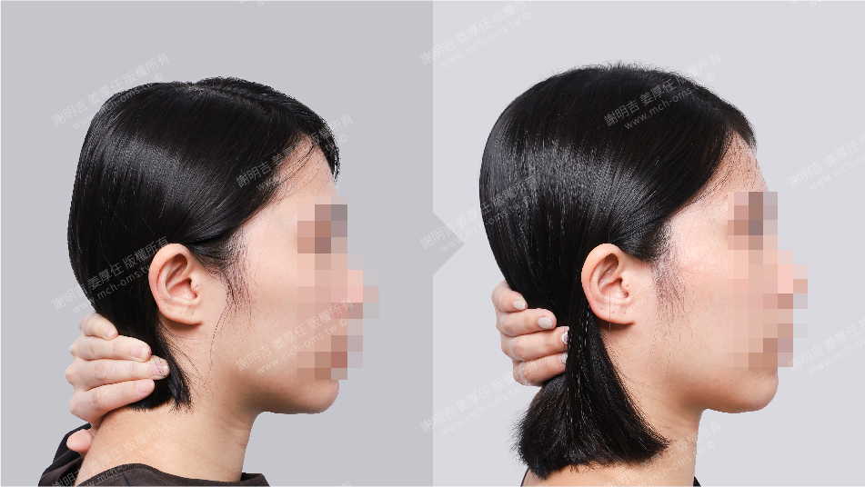 後腦勺 扁頭 手術