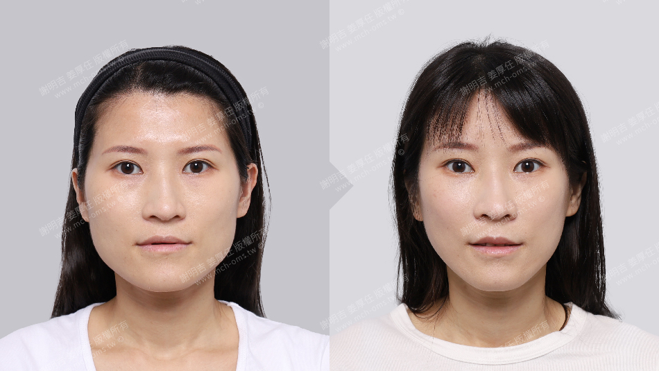 正顎手術 恢復期 手術前後比較 手術照片 手術案例 削骨手術