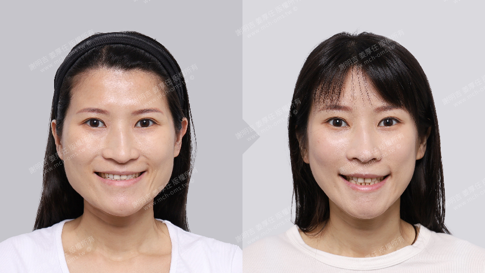 正顎手術 恢復期 手術前後比較 手術照片 手術案例 削骨手術