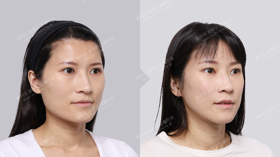 正顎手術 恢復期 手術前後比較 手術照片 手術案例 削骨手術