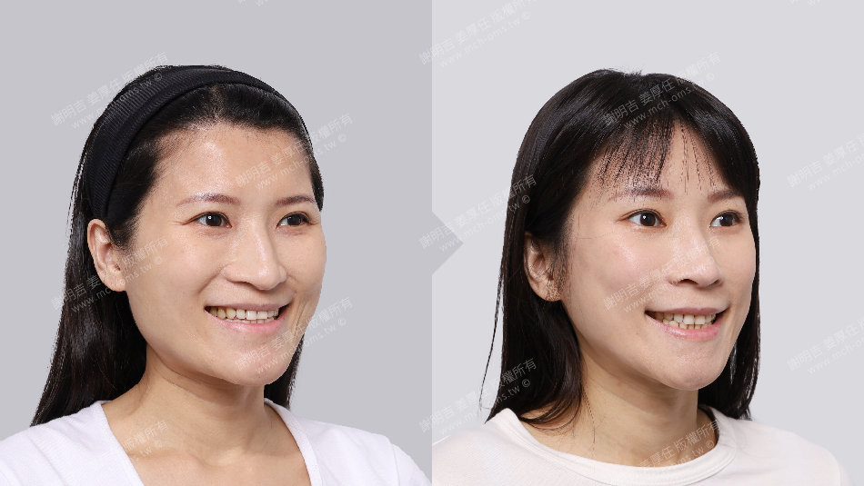 正顎手術 恢復期 手術前後比較 手術照片 手術案例 削骨手術