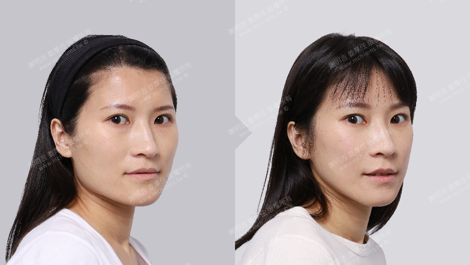 正顎手術 恢復期 手術前後比較 手術照片 手術案例 削骨手術