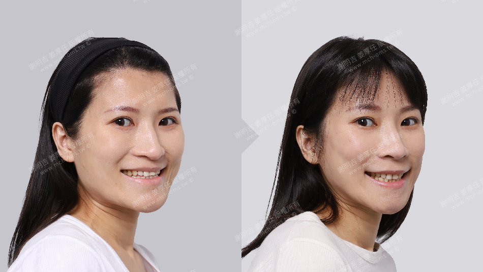 正顎手術 恢復期 手術前後比較 手術照片 手術案例 削骨手術