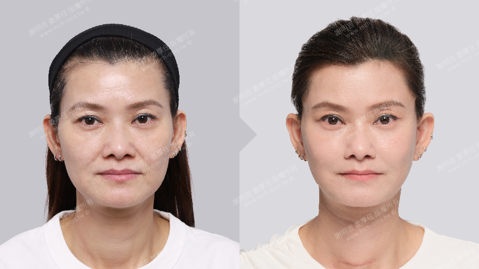 正顎手術 恢復期 手術前後比較 手術照片 手術案例 削骨手術