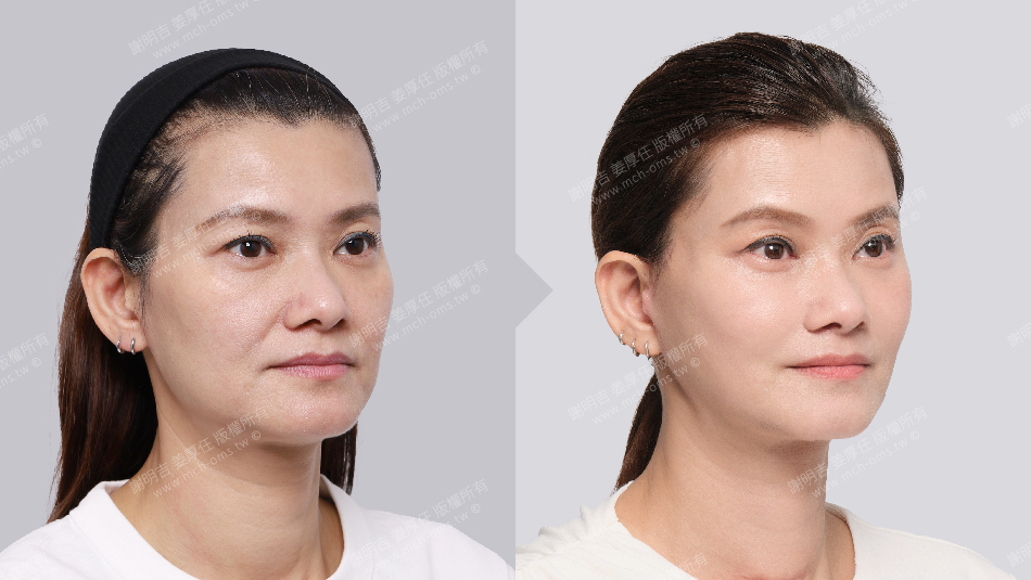正顎手術 恢復期 手術前後比較 手術照片 手術案例 削骨手術