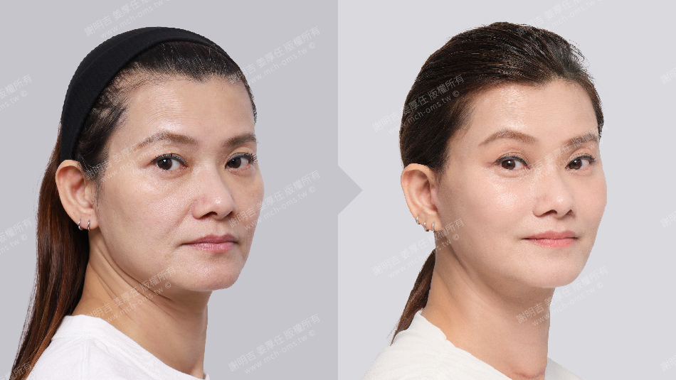 正顎手術 恢復期 手術前後比較 手術照片 手術案例 削骨手術