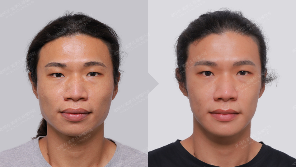 Mr. H 术前术后对比 5