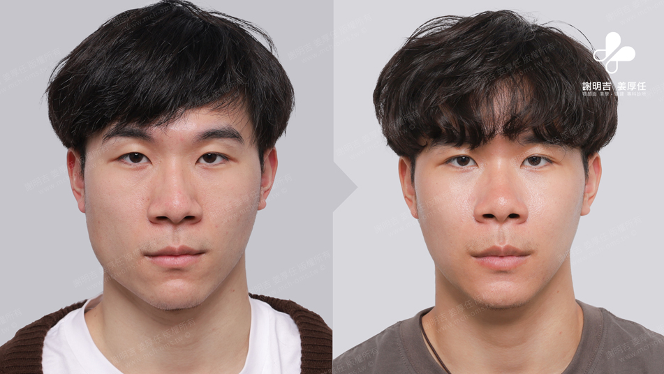 SMK before and after comparison 1