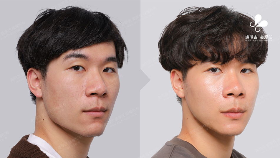 SMK before and after comparison 2