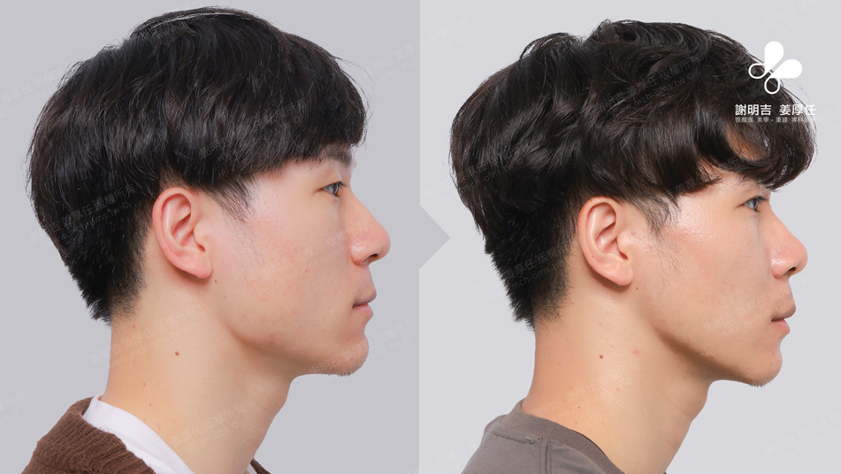 SMK before and after comparison 3