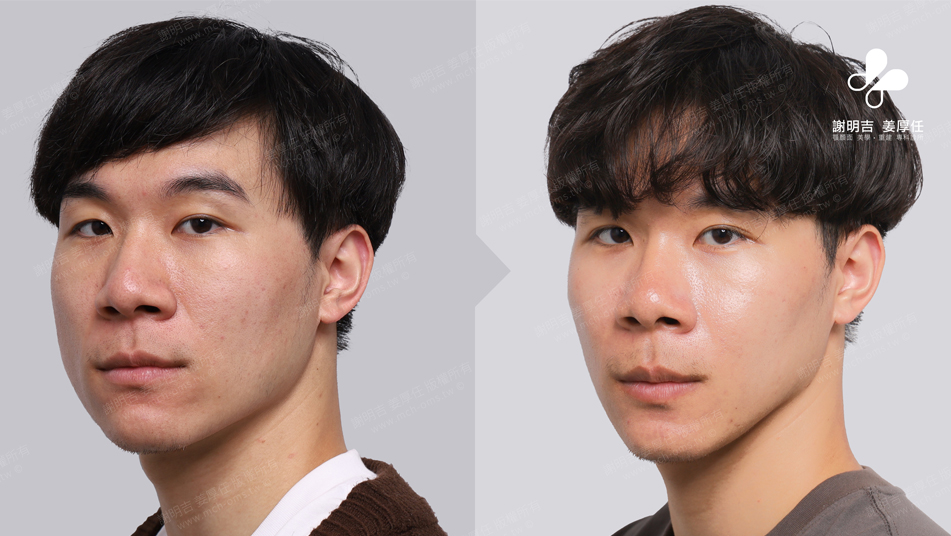 SMK before and after comparison 4
