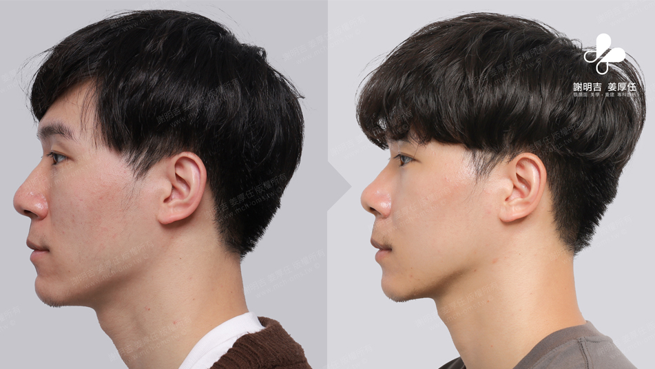 SMK before and after comparison 5