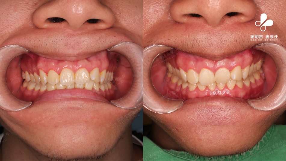 SMK before and after comparison 6