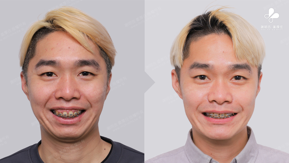 WWN 術前術後對比 11