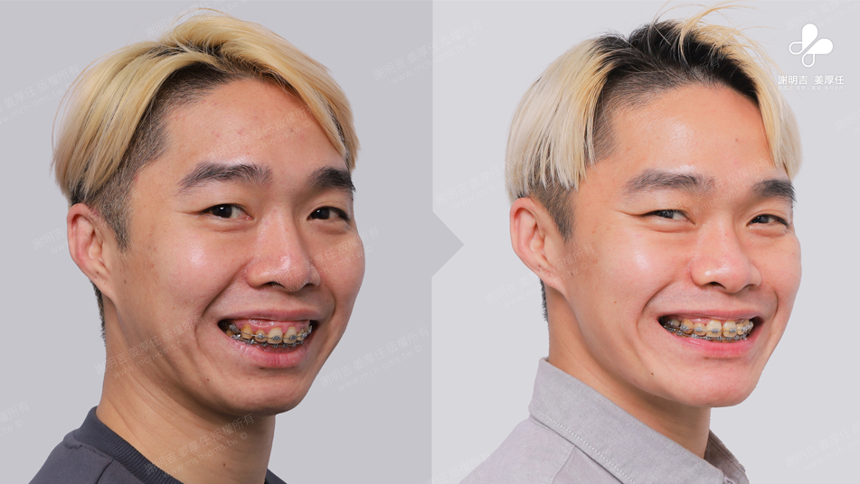 WWN 術前術後對比 13