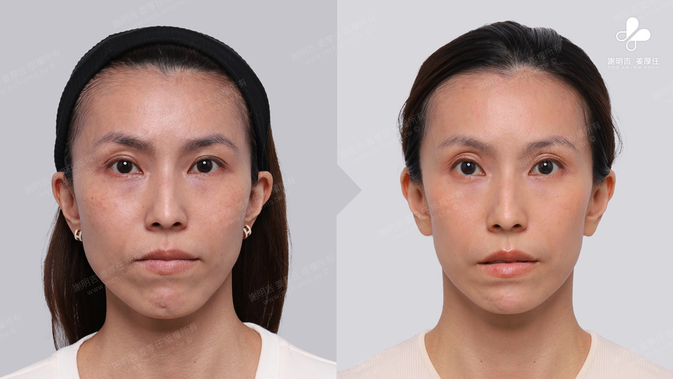 Mrs. Chang before and after comparison 1