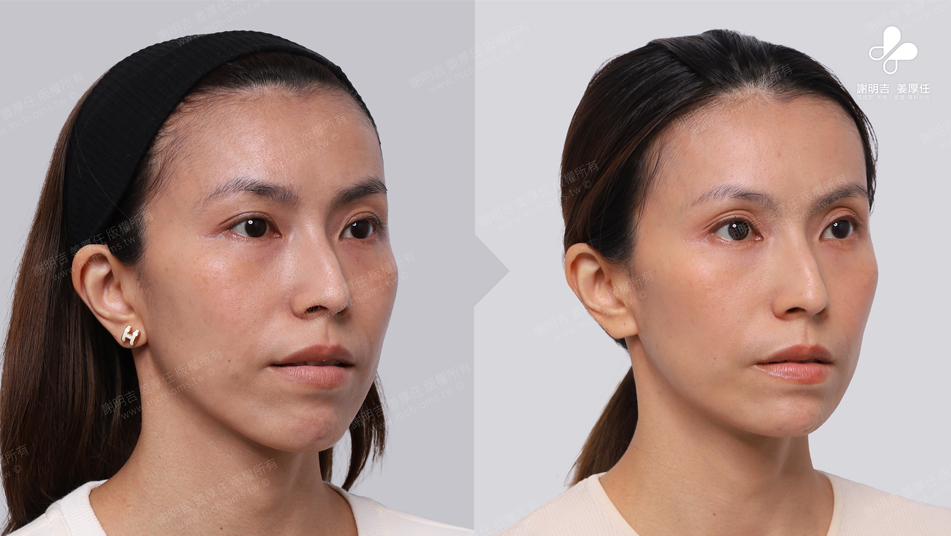 Mrs. Chang before and after comparison 2