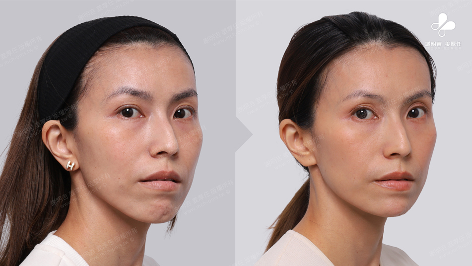 Mrs. Chang before and after comparison 3
