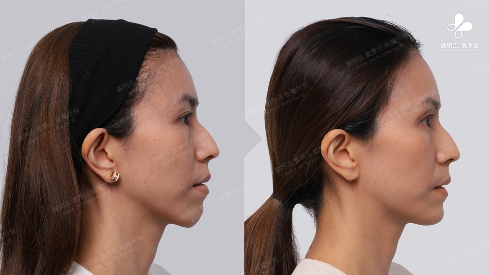 Mrs. Chang before and after comparison 4