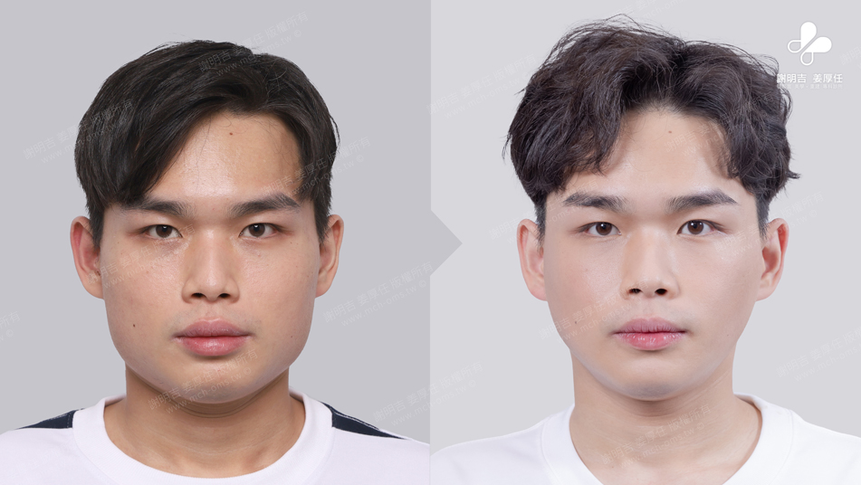 Mr. Lee 术前术后对比 11