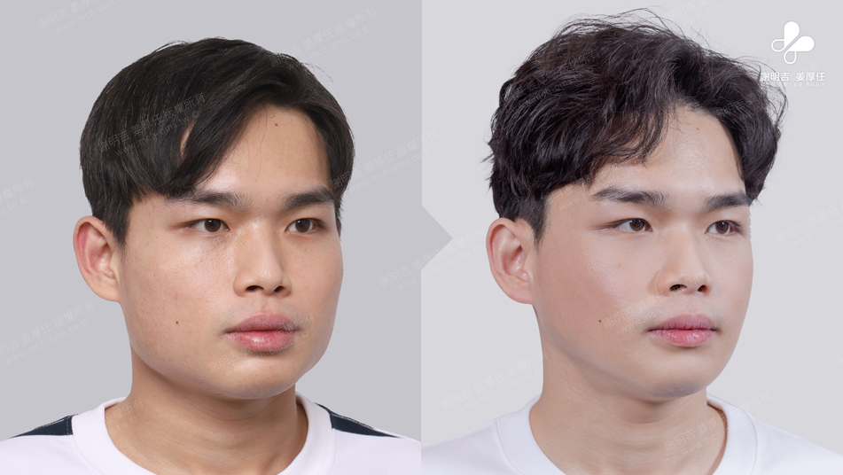 Mr. Lee 术前术后对比 12